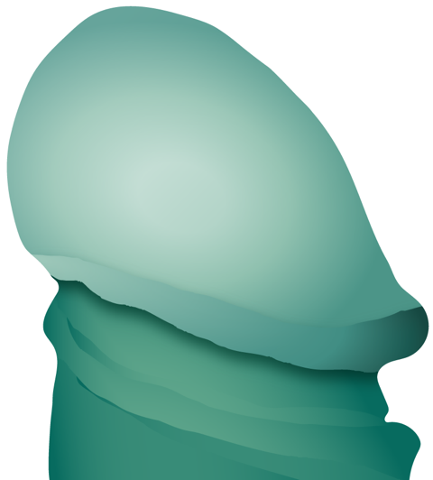 Darstellung Penis mit ausbehandelten Honrzipfel - Illustration